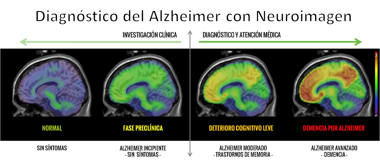 neuroimagen-alzheimer