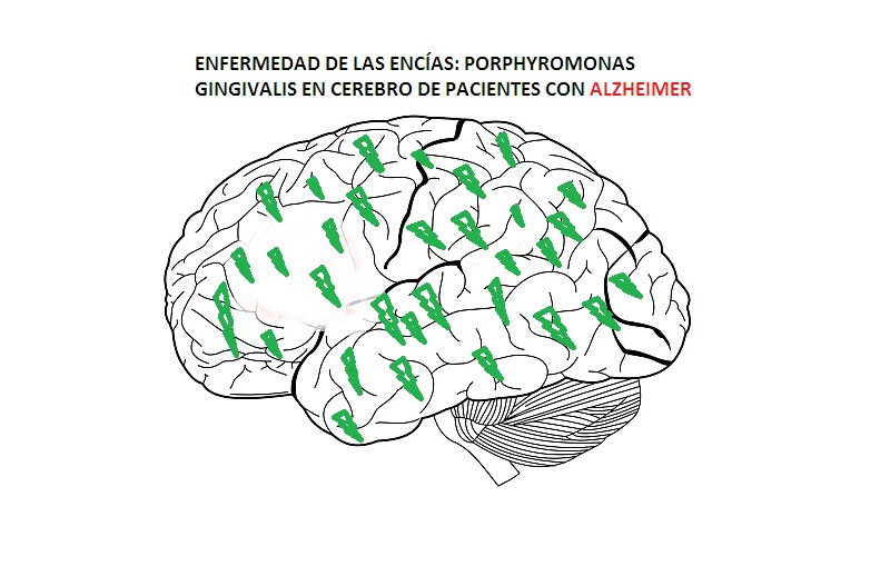 ENFERMEDAD-ENCIAS-ALZHEIMER